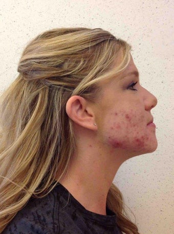 accutane costs