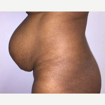 Umbilical Hernia Repair Suegery Cost Realself He also had an infected umbilical cord. umbilical hernia repair suegery cost