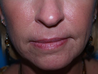 dermabrasion before lines mouth around realself
