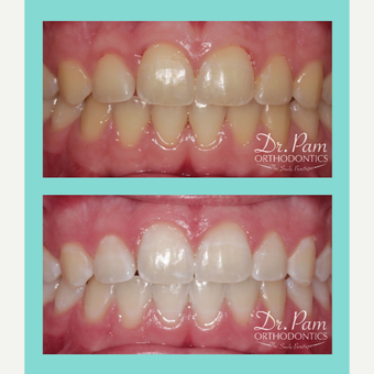 before and after zoom whitening