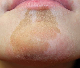 birthmark removal cost near me