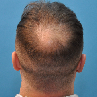 Hair Transplant Before & After Pictures - RealSelf