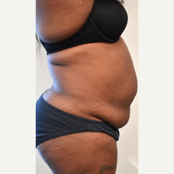 Tummy Tuck Before and After Photo Gallery