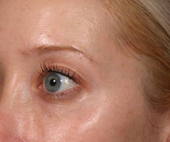 Restylane under eyes photo from Elizabeth F. Rostan, MD, Charlotte ...