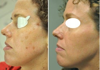 Yag Laser Types Treatment Cost Realself