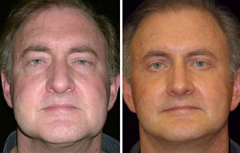 55 year old male, rhinoplasty photo from Miguel Delgado, MD, San ...