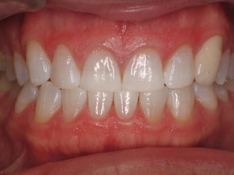 zoom whitening