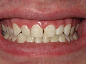 ICON- White Spot Treatment photo from Wendy S. Spektor, DDS, Bellevue ...