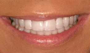 zoom teeth whitening foods to avoid