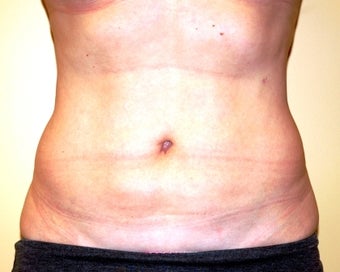 plastic surgery and ultrasound assisted liposuction Liposuction has evolved over the last 15 years with the introduction of the tumescent and super-wet techniques, ultrasonic assisted liposuction, power assisted liposuction and laser lipolysis these advances have made possible the removal of larger volumes of fat with negligible blood loss and relatively trifle complications. plastic surgery and ultrasound assisted liposuction Liposuction has evolved over the last 15 years with the introduction of the tumescent and super-wet techniques, ultrasonic assisted liposuction, power assisted liposuction and laser lipolysis these advances have made possible the removal of larger volumes of fat with negligible blood loss and relatively trifle complications.