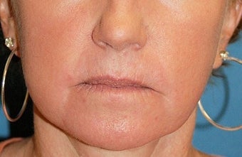 CO2 Laser Before & After Pictures - RealSelf