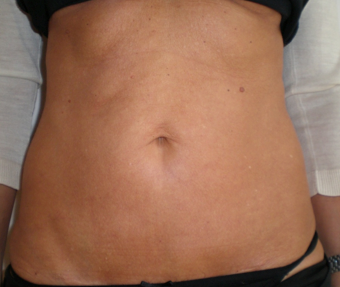 tripollar before realself woman tightening skin