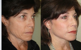 Image Lift, Fractional CO2 Laser Skin Treatment photo from Richard …