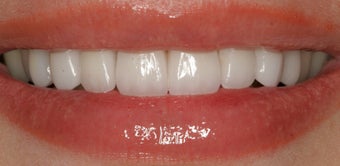 Porcelain Veneers after 88894