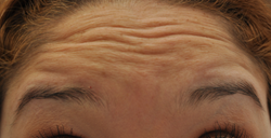 Botox to forehead and glabella before 426035