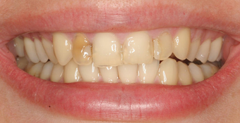 Porcelain Veneers before 88894