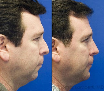 Rhinoplasty, Sliding Genioplasty, Neck liposuction photo from Thomas A ...