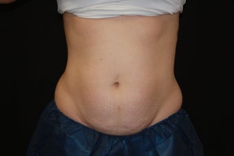 CoolSculpting Before & After Pictures - RealSelf