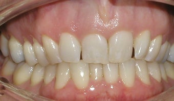 Invisalign Before & After Pictures - RealSelf