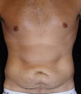 tummy tuck cost