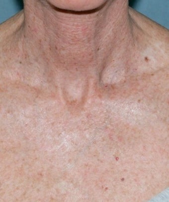 Fractional CO2 Laser Treatment photo from Richard Fitzpatrick, MD (in ...