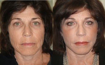 Image Lift, Fractional CO2 Laser Skin Treatment photo from Richard …