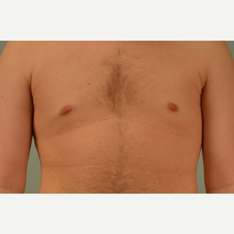 Liposuction Before & After Pictures - RealSelf