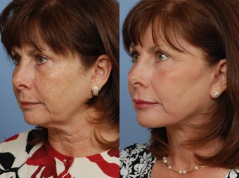 before and after image