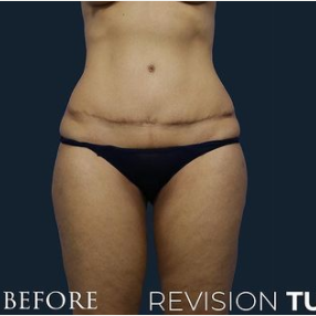 Tummy Tuck Revision Before & After Pictures - RealSelf