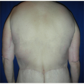 Back Lift (Bra Line Back Lift) Before and After Pictures Case 1097, Los  Angeles, CA