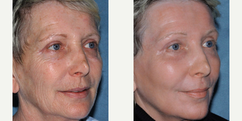 before and after image