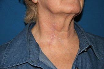 Tethered Neck Scar Revision photo from Gregory Park, MD, San Diego ...