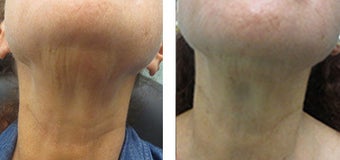 Ultherapy Before & After Pictures - RealSelf