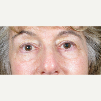 The best surgical and nonsurgical options for under eye bags