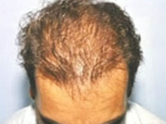 Mesotherapy Before & After Pictures - RealSelf