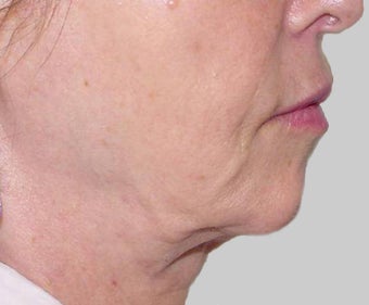 Exilis Ultra Skin Tightening Before & After Photos Patient 34, Washington,  DC