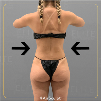Pin on AirSculpt® Before & After - Elite Body Sculpture