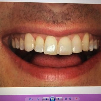 Dental Bonding Before & After Pictures - RealSelf