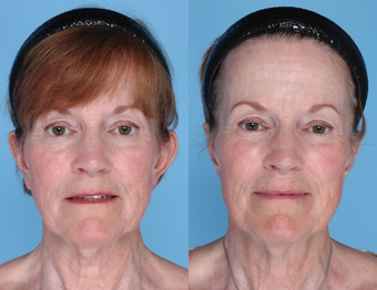 before and after image