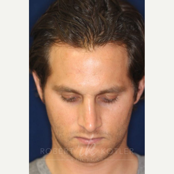 Mister Mark Silicone Injections