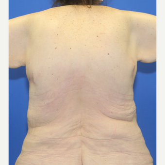 Back Lift (Upper Body Lift) Before and After Pictures Case 11677