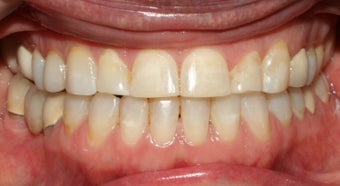 Adult TMJ and orthodontic treatment after 222992
