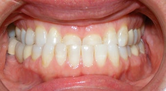 Adult TMJ and orthodontic treatment before 222992
