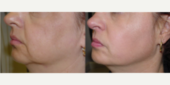before and after image