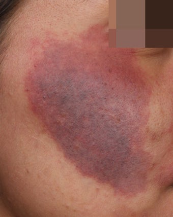 birthmark removal cost near me