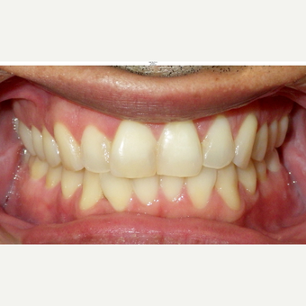 zoom whitening before and after photos