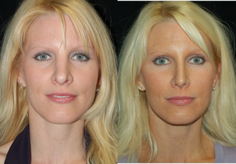 before and after image