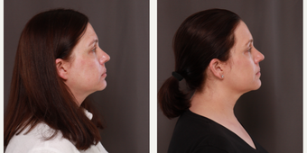 before and after image