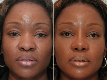 African American Rhinoplasty Before & After Pictures - RealSelf