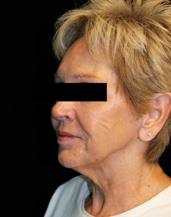 TriPollar Before & After Pictures - RealSelf
